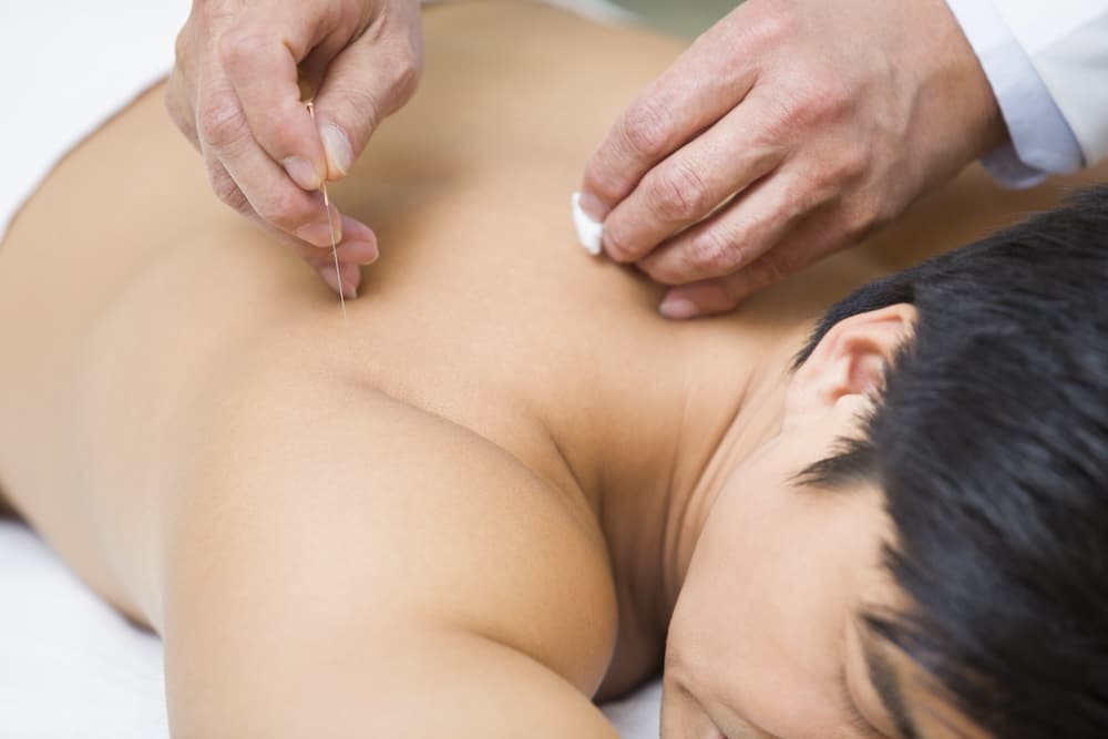 Patient receiving acupuncture