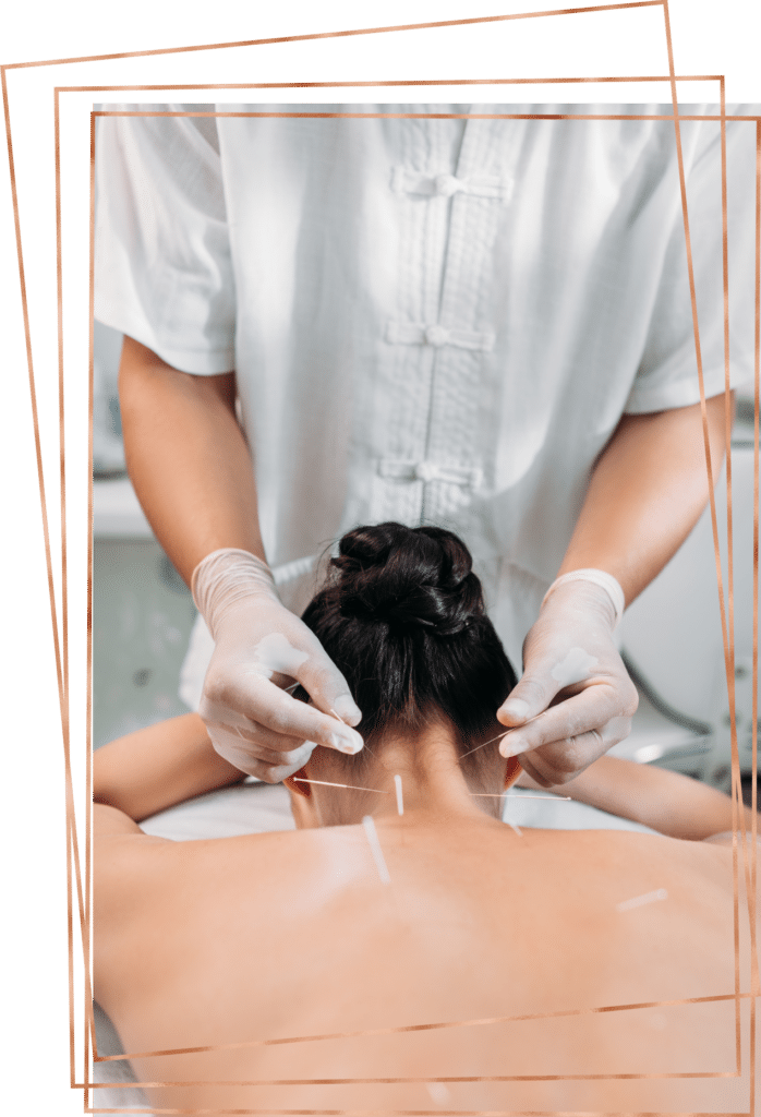 Woman lying down on her back getting acupuncture treatment