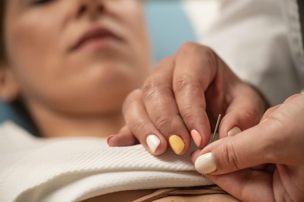 Close up photo of woman's hands providing acupuncture therapy for stress relief